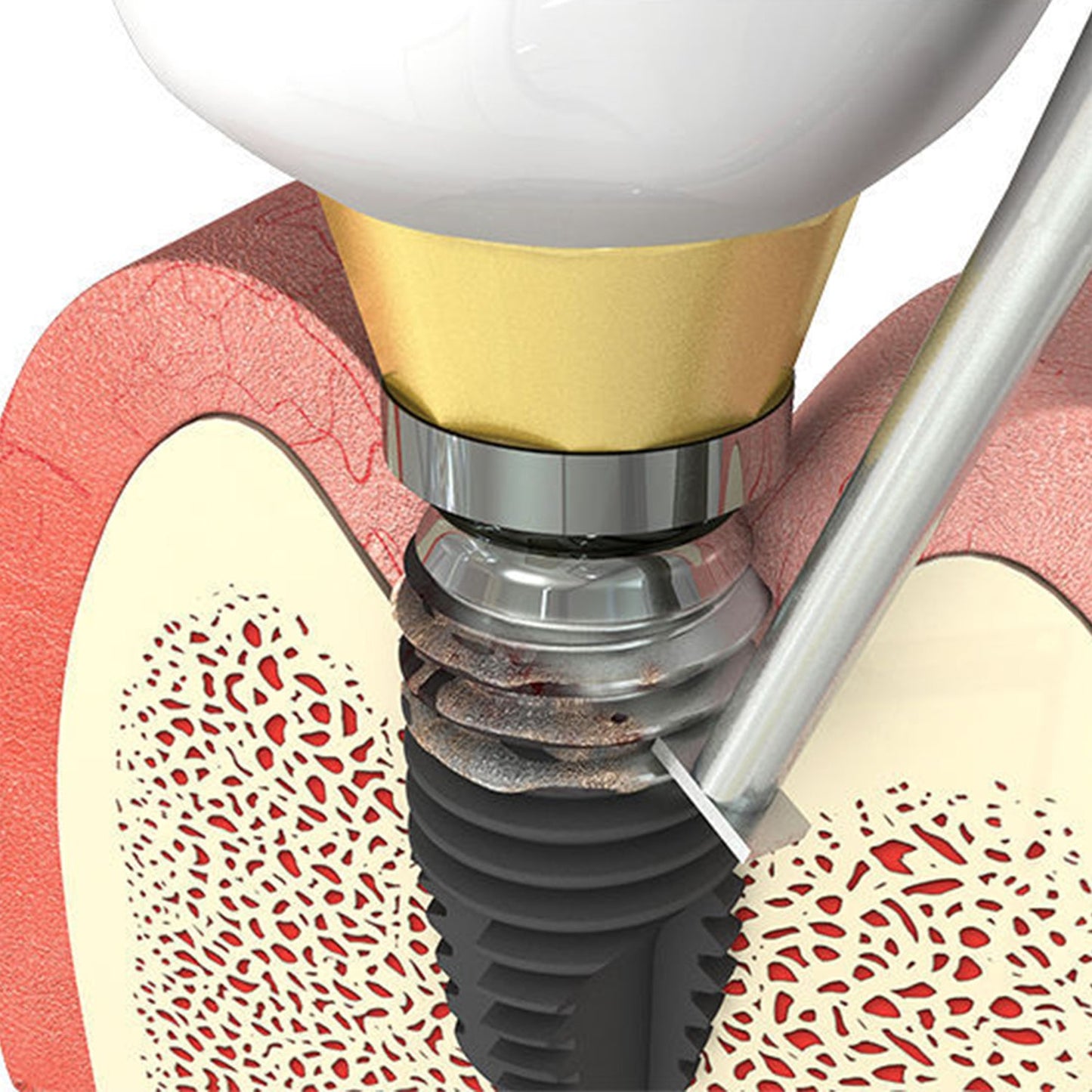 T-Brush Peri-Implantitis Brush