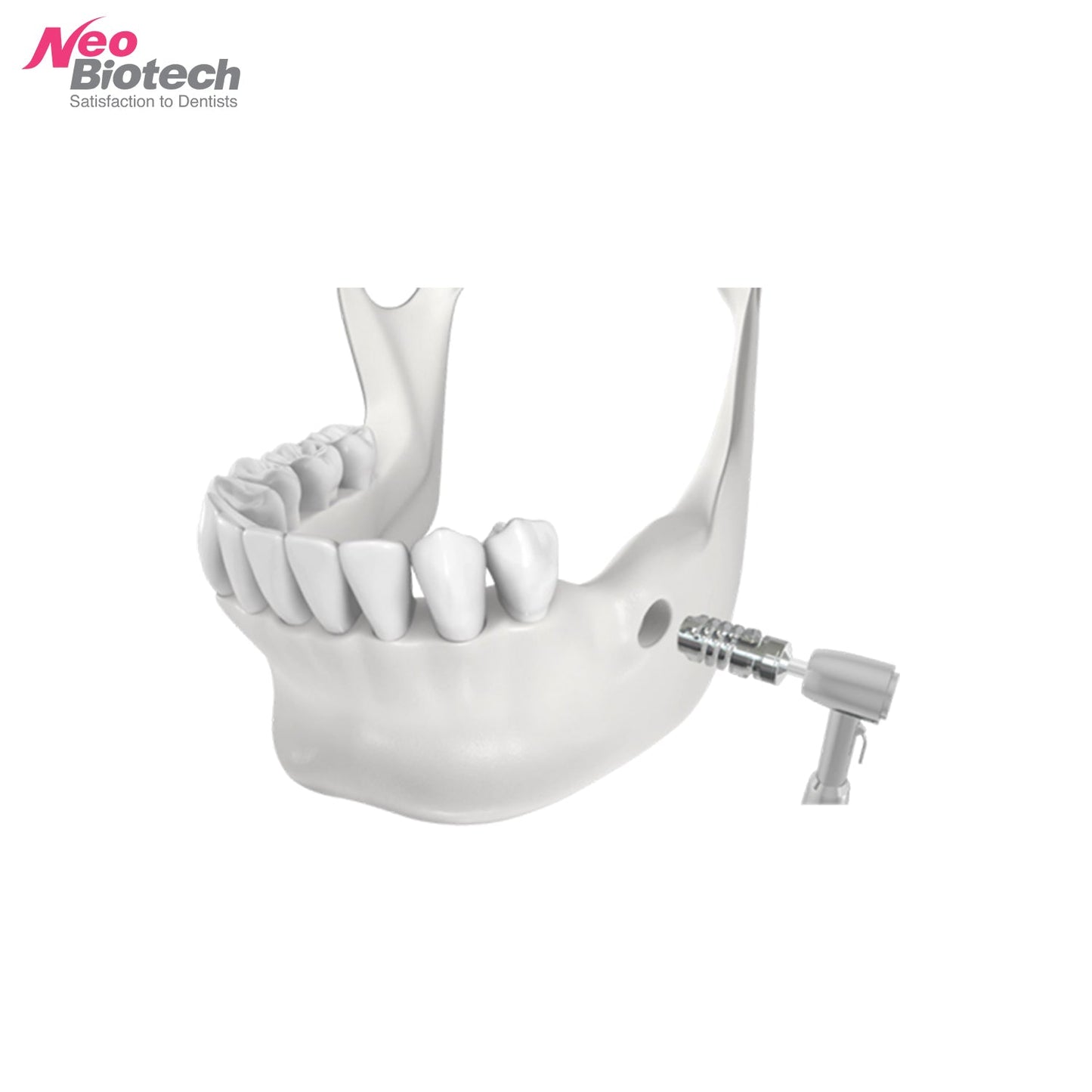 ACM Autobone Chip Maker - Bone Harvesting Burr