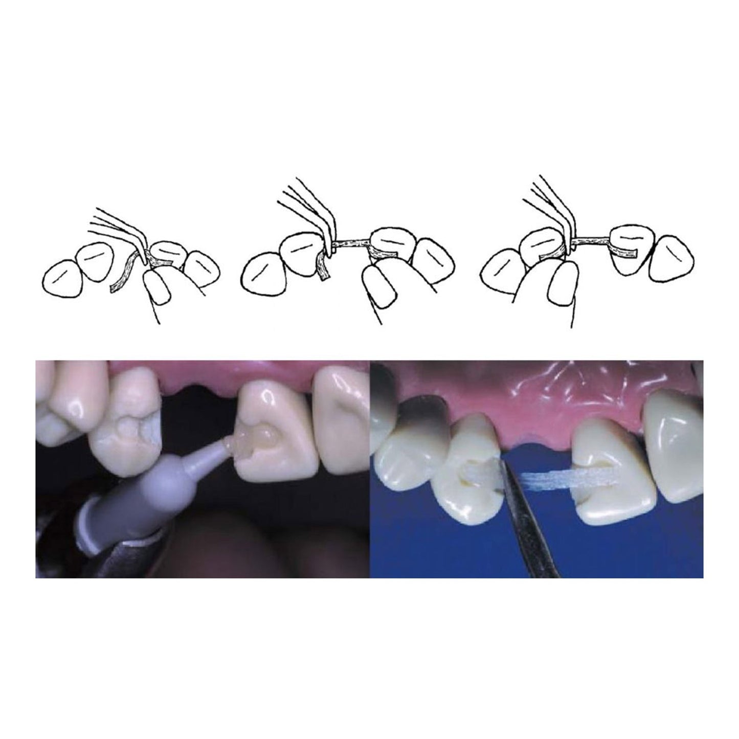 Ribbond Ultra Fiber Splint Refill 22 cm