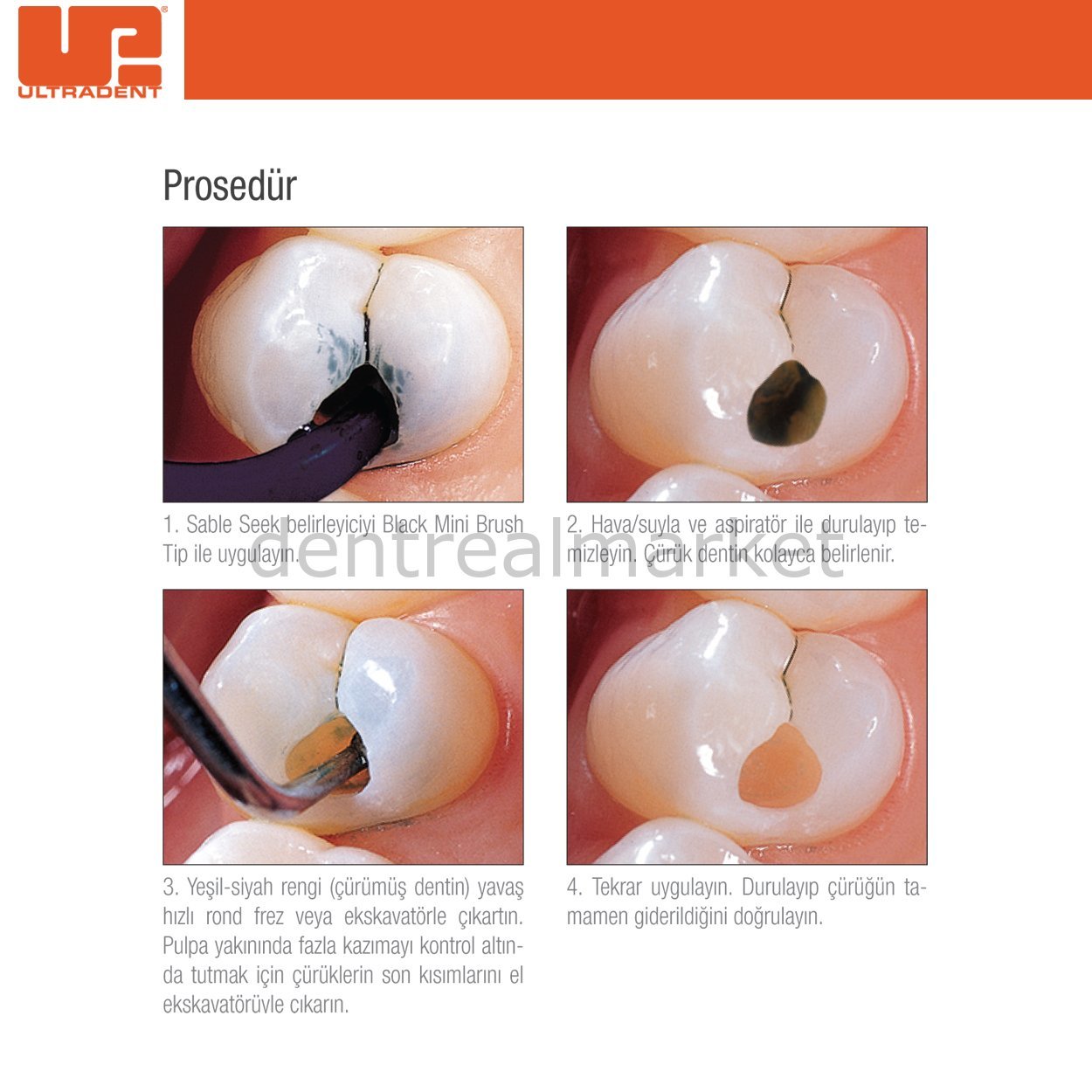 DentrealStore - Ultradent Sable Seek Caries Detection Kit
