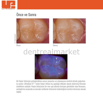 Ultradent - UltraSeal XT Hydro Hydrophilic Pit and Fissure Sealant